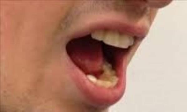 مواد غذایی که موجب بروز سندرم آلرژی دهانی می شوند